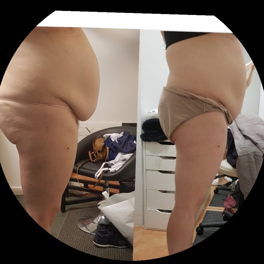 Aldegazar, eliminar celulitis, bajar de peso, reducir volumen Aldegazar, eliminar celulitis, bajar de peso, reducir volumen