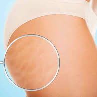celulitis celulitis